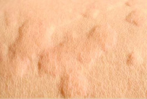 picture of contact dermatitis skin rash